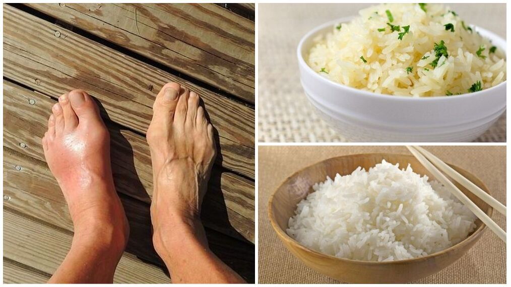 Recoméndase unha dieta a base de arroz para pacientes con gota. 